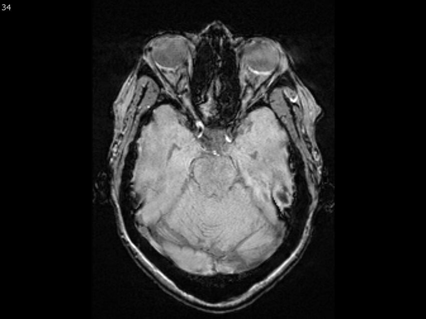 Atypical meningioma - intraosseous (Radiopaedia 64915-74572 Axial SWI 34).jpg
