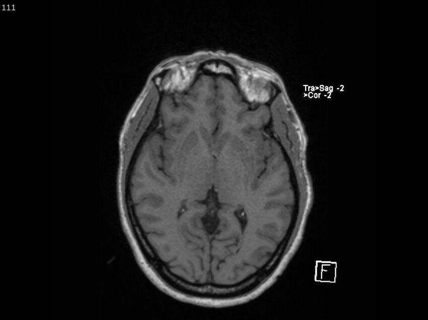 Atypical meningioma - intraosseous (Radiopaedia 64915-74572 Axial T1 111).jpg
