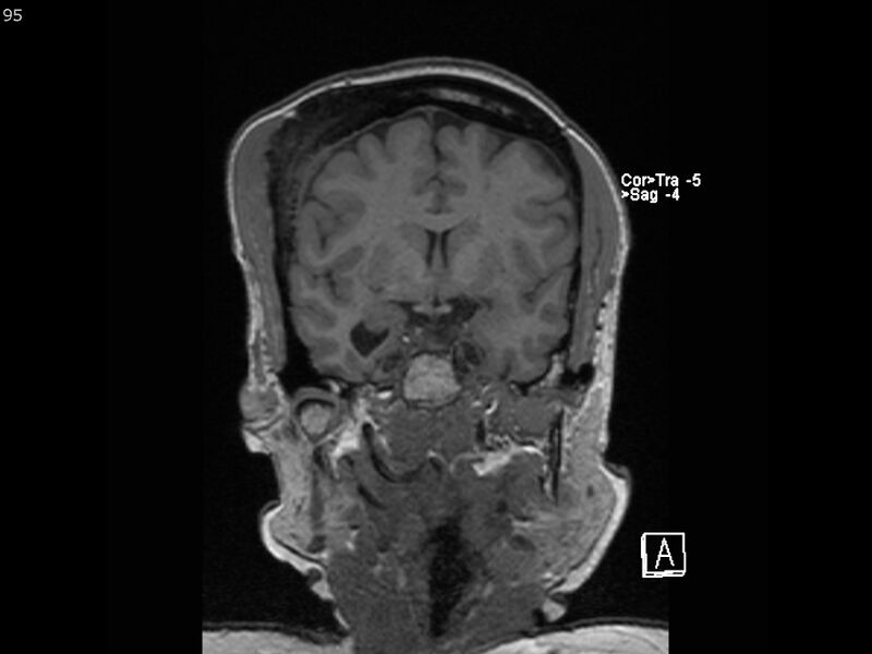 File:Atypical meningioma - intraosseous (Radiopaedia 64915-74572 Coronal T1 95).jpg