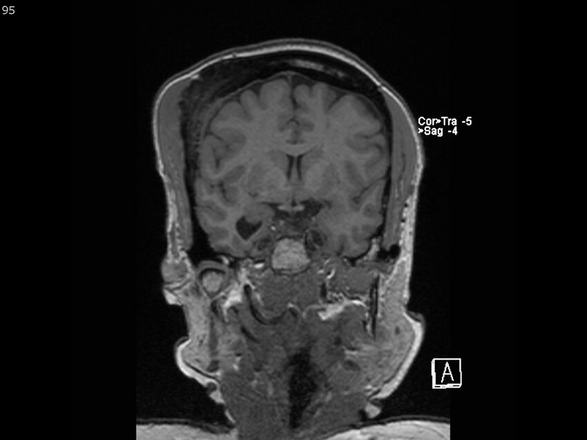 Atypical meningioma - intraosseous (Radiopaedia 64915-74572 Coronal T1 95).jpg