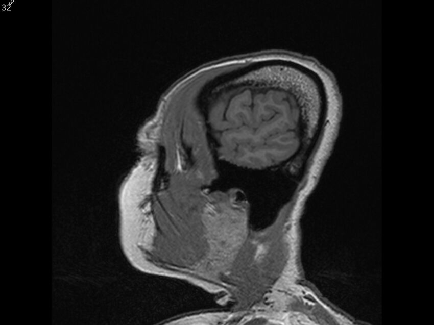 Atypical meningioma - intraosseous (Radiopaedia 64915-74572 Sagittal T1 32).jpg