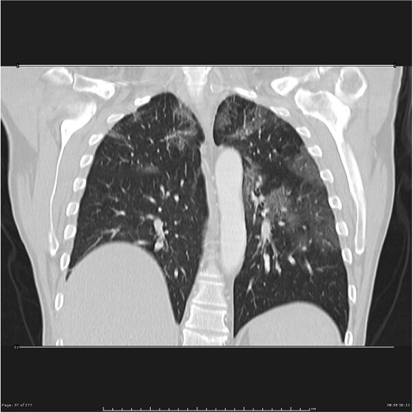 File:Atypical pneumonia - Q fever (Radiopaedia 21993-21989 C 30).jpg