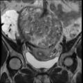 Atypical retroperitoneal lymphocoeles with large leiomyoma of uterus (Radiopaedia 32084-33027 Coronal T2 17).jpg