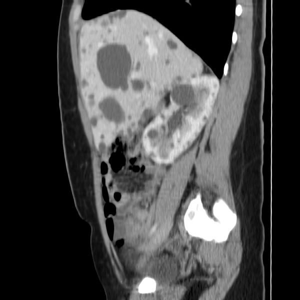 File:Autosomal dominant polycystic kidney disease (Radiopaedia 23061-23093 F 18).jpg