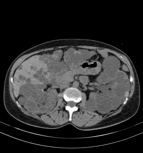 File:Autosomal dominant polycystic kidney disease (Radiopaedia 41918-44922 Axial non-contrast 12).jpg