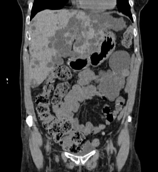 File:Autosomal dominant polycystic kidney disease (Radiopaedia 41918-44922 Coronal non-contrast 5).jpg