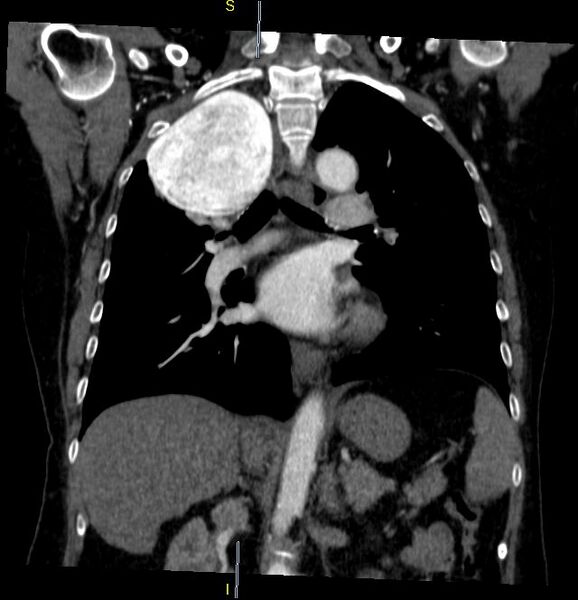 File:Azygos vein aneurysm (Radiopaedia 77824-90130 C 20).JPG