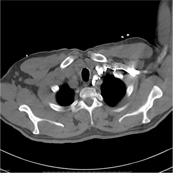File:Azygos venous system anatomy (CT pulmonary angiography) (Radiopaedia 25928-26077 Axial C+ CTPA 8).jpg