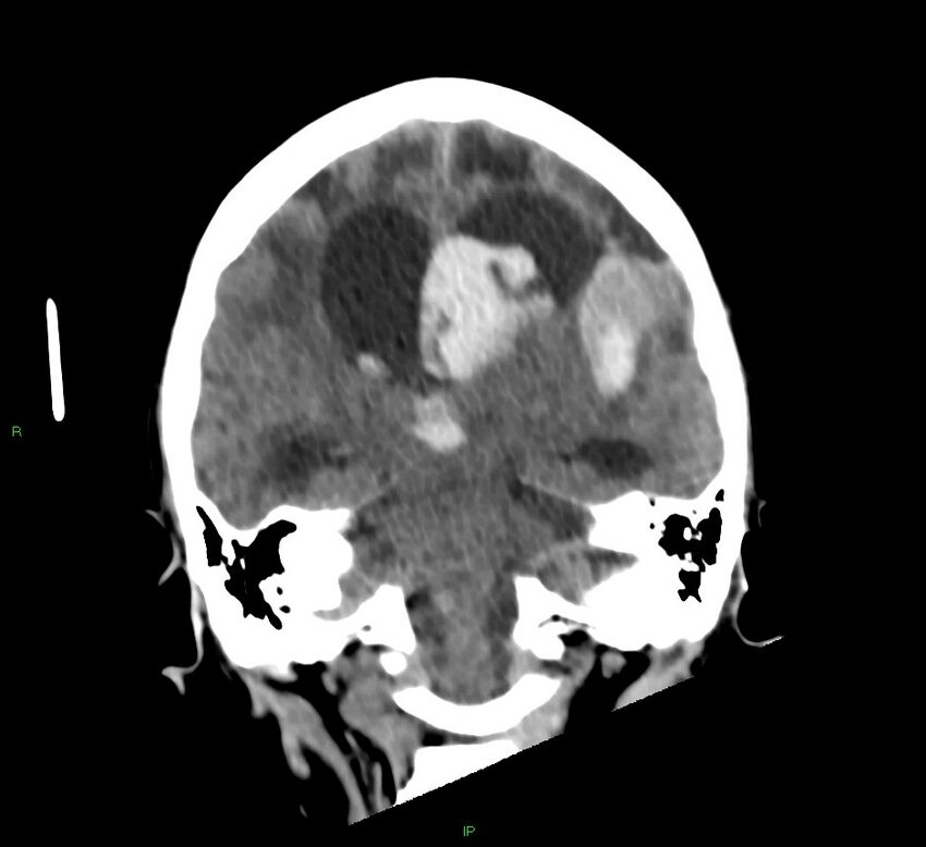 Basal ganglia hemorrhage (Radiopaedia 58766-65988 Coronal non-contrast 33).jpg