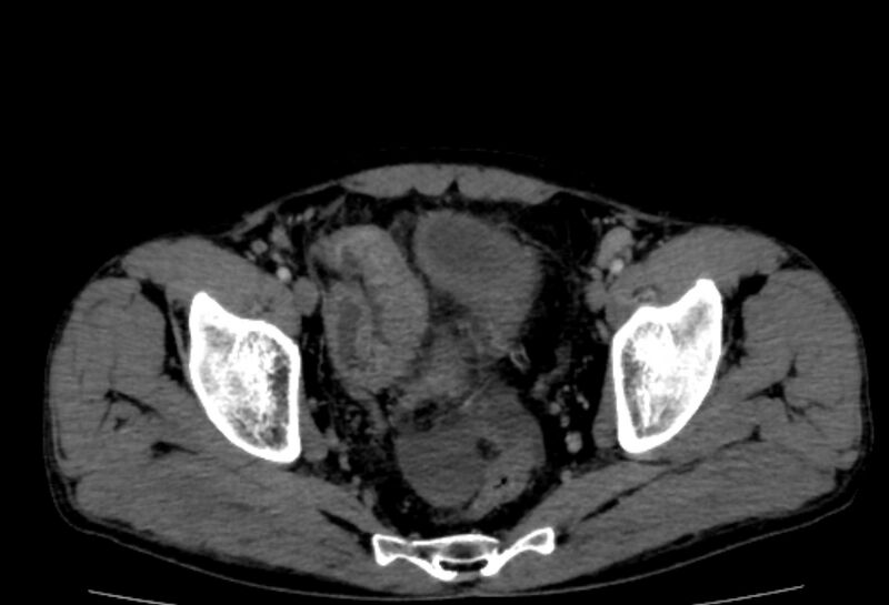 File:Behçet's disease- abdominal vasculitis (Radiopaedia 55955-62570 A 81).jpg