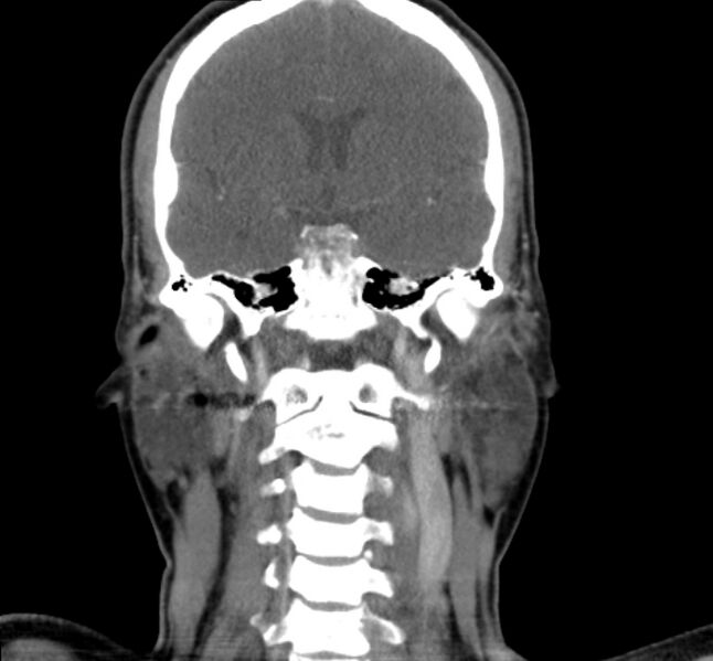 File:Benign mixed salivary tumor of the parotid gland (Radiopaedia 35261-36792 B 18).jpg