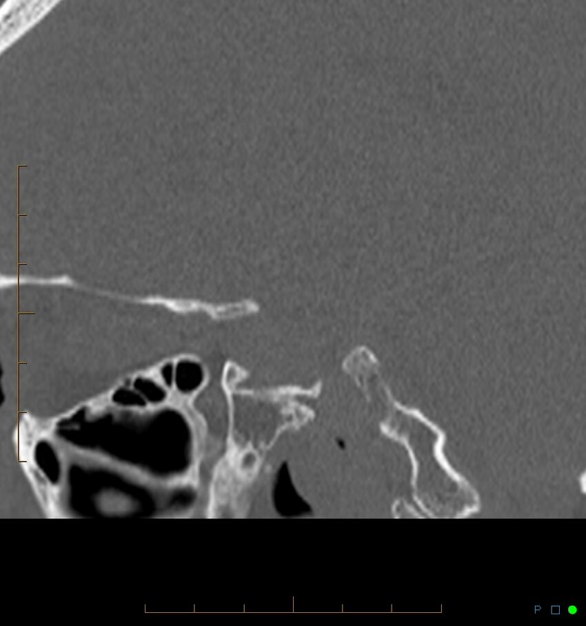 Benign notochordal cell tumor (probable) (Radiopaedia 65475-74546 Sagittal bone window 41).jpg