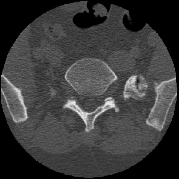 File:Bertolotti syndrome (Radiopaedia 24864-25128 Axial bone window 20).jpg