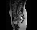 Bicornuate bicollis uterus (Radiopaedia 61626-69616 Sagittal T2 14).jpg