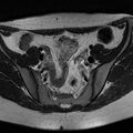 Bicornuate uterus (Radiopaedia 72135-82643 Axial T2 5).jpg