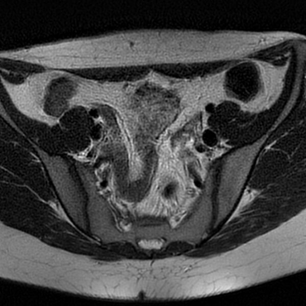 File:Bicornuate uterus (Radiopaedia 72135-82643 Axial T2 5).jpg