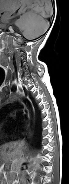 File:Bilateral Sprengel deformity with Klippel-Feil syndrome (Radiopaedia 66395-75650 Sagittal T1 10).jpg