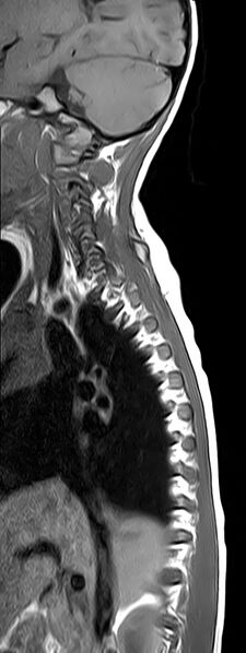 File:Bilateral Sprengel deformity with Klippel-Feil syndrome (Radiopaedia 66395-75650 Sagittal T1 2).jpg