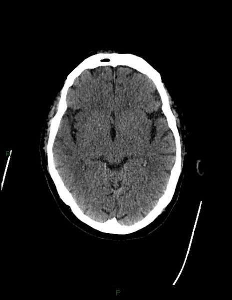 File:Bilateral acute middle cerebral artery territory infarcts (Radiopaedia 77319-89401 Axial non-contrast 38).jpg