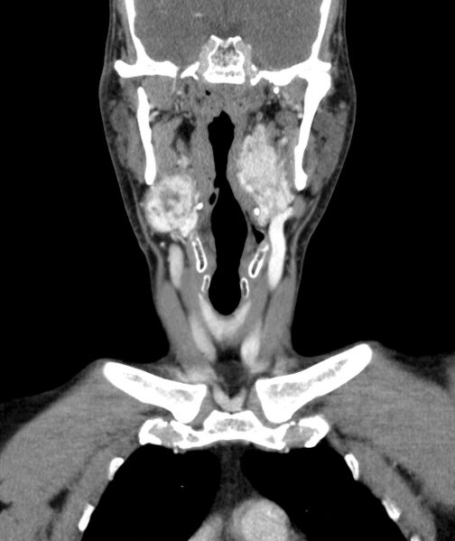 File:Bilateral carotid body tumors (Radiopaedia 52899-58827 B 10).jpg
