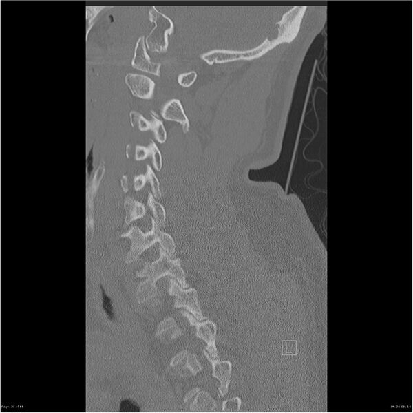 File:Bilateral cervical ribs (Radiopaedia 25868-26017 Sagittal bone window 25).jpg