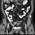 Bilateral direct inguinal herniae (Radiopaedia 17016-16719 A 12).jpg