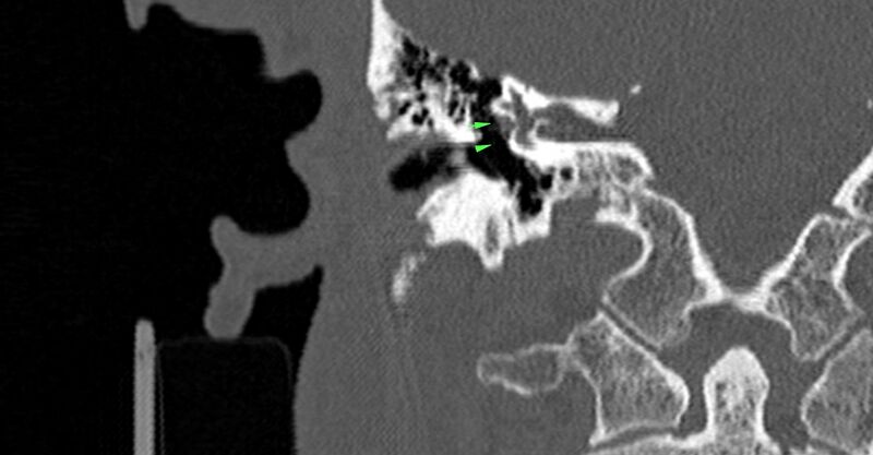 File:Bilateral temporal bone fractures (Radiopaedia 29482-29970 Coronal non-contrast 109).jpg