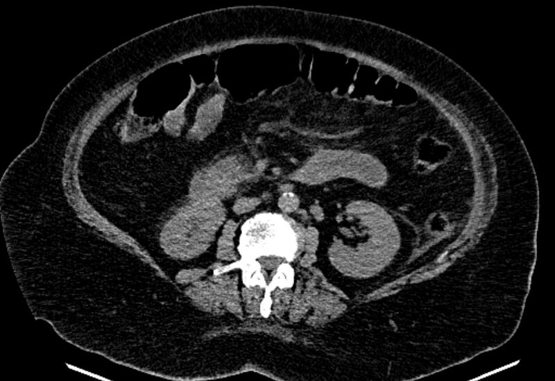 File:Biliary pancreatitis (Radiopaedia 72289-82823 Axial non-contrast 129).jpg