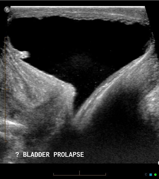 File:Bladder prolapse into vagina (Radiopaedia 18073-17849 A 1).jpg