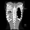 Bochdalek diaphragmatic hernia (Radiopaedia 38866-41059 Coronal liver window 19).jpg