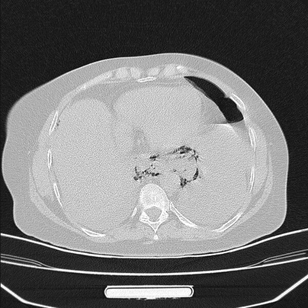 File:Boerhaave syndrome (Radiopaedia 45644-49799 Axial lung window 85).jpg