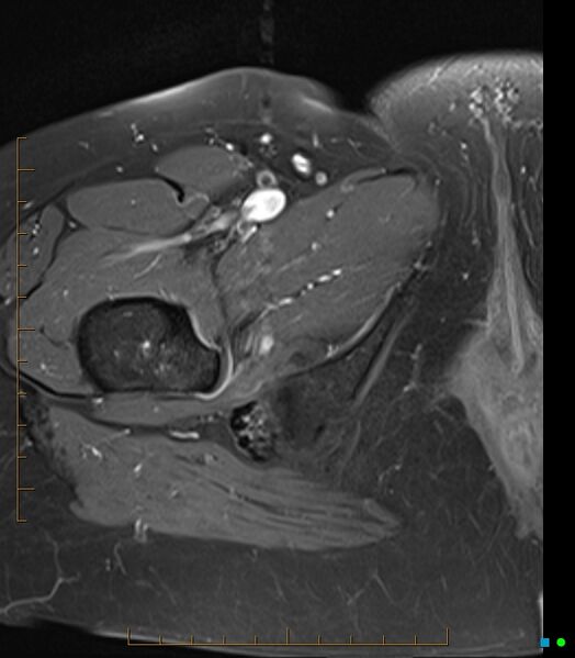 File:Bone metastasis - breast cancer (Radiopaedia 16667-16374 Axial T1 C+ fat sat 2).jpg