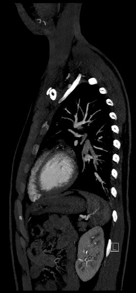 File:Brachiocephalic trunk pseudoaneurysm (Radiopaedia 70978-81191 C 68).jpg