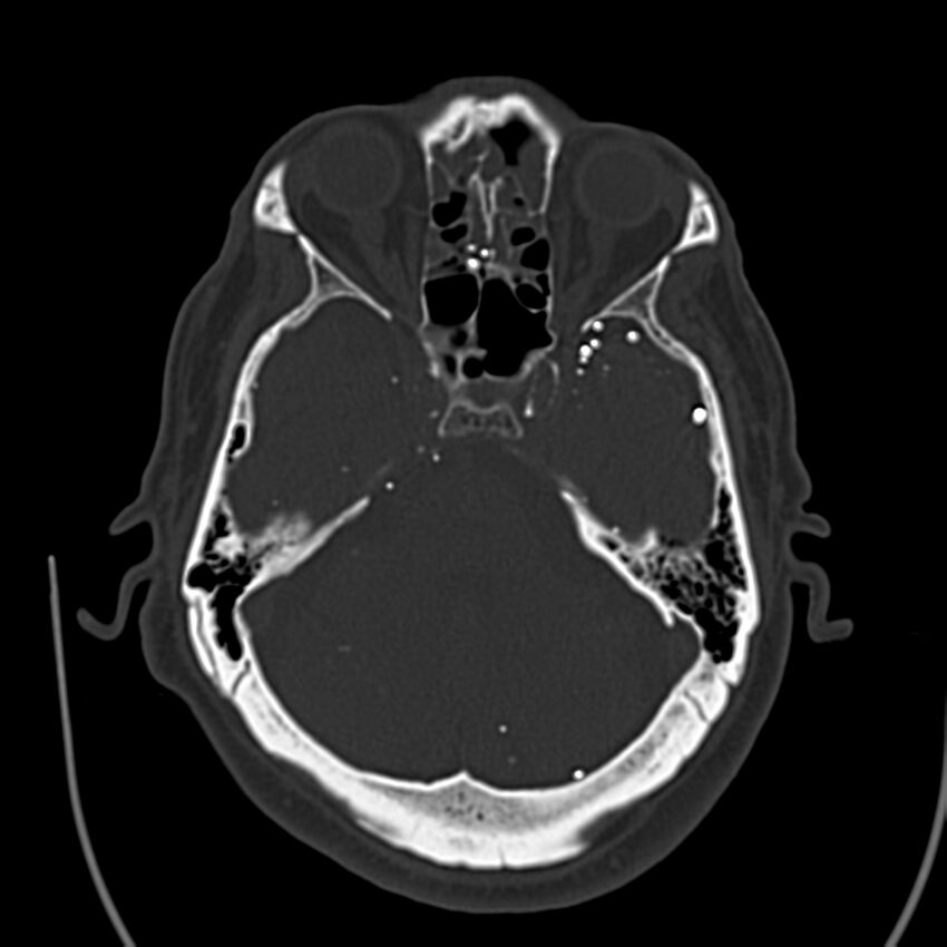 Brain Pantopaque remnants (Radiopaedia 78403-91048 Axial bone window 26).jpg