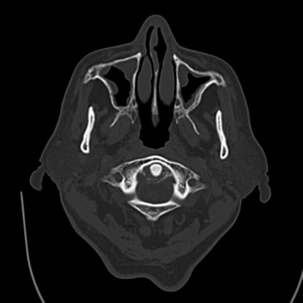 File:Brain Pantopaque remnants (Radiopaedia 78403-91048 Axial bone window 9).jpg