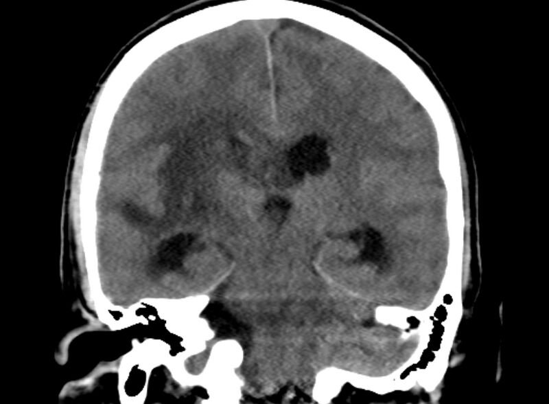 File:Brain abscess complicated by intraventricular rupture and ventriculitis (Radiopaedia 82434-96575 Coronal non-contrast 15).jpg