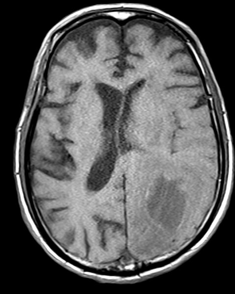 File:Brain abscess with dual rim sign (Radiopaedia 87566-103938 Axial T1 14).jpg