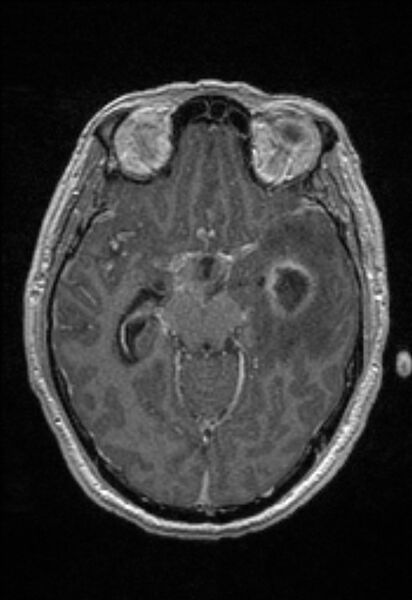 File:Brain abscess with ventriculitis (Radiopaedia 85703-101495 Axial T1 C+ 75).jpg