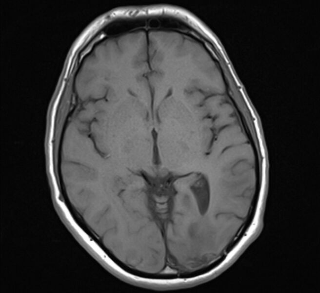 File:Brain metastases - lung cancer primary (Radiopaedia 75060-86115 Axial T1 13).jpg