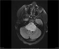 Brainstem glioma (Radiopaedia 21819-21775 Axial FLAIR 10).jpg