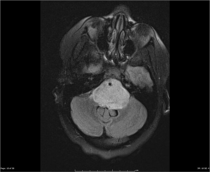 File:Brainstem glioma (Radiopaedia 21819-21775 Axial FLAIR 10).jpg