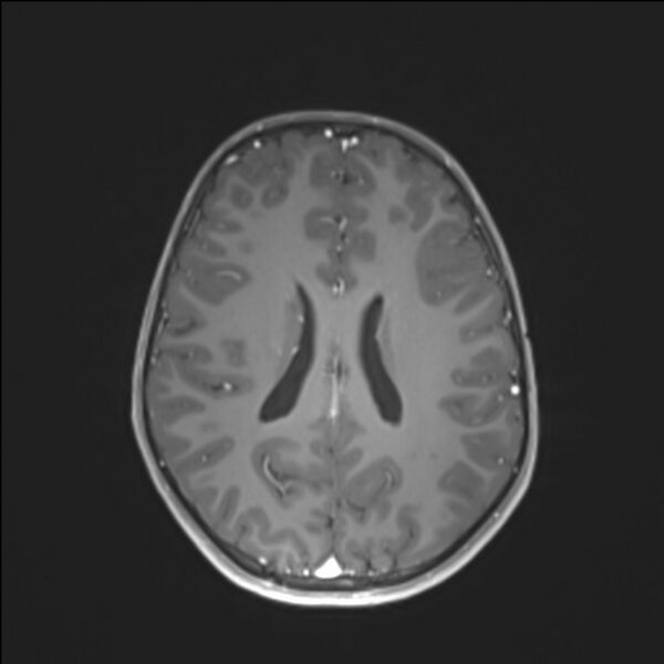 File:Brainstem glioma (Radiopaedia 70548-80674 Axial T1 C+ 101).jpg