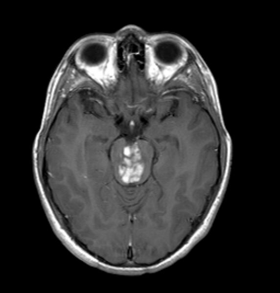 File:Brainstem glioma - focal midbrain (Radiopaedia 6525-7840 Axial T1 C+ 1).jpg