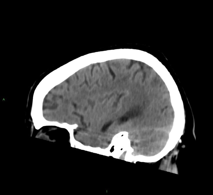 Brainstem hemorrhage (Radiopaedia 58794-66028 C 14).jpg