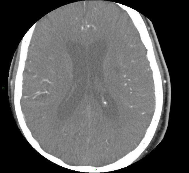 File:Brainstem hemorrhage (Radiopaedia 58794-66028 D 115).jpg
