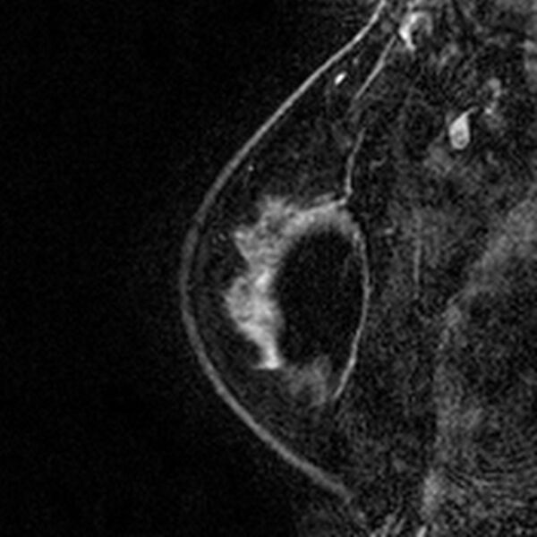 File:Breast implants - MRI (Radiopaedia 26864-27035 Sagittal T2 11).jpg