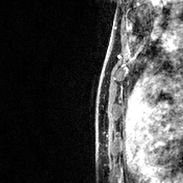 File:Breast implants - MRI (Radiopaedia 26864-27035 Sagittal T2 54).jpg