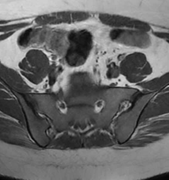 File:Broad ligament leiomyoma (Radiopaedia 81634-95516 Axial T1 3).jpg