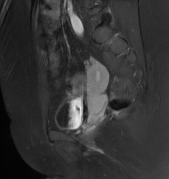 File:Broad ligament leiomyoma (Radiopaedia 81634-95516 G 19).jpg