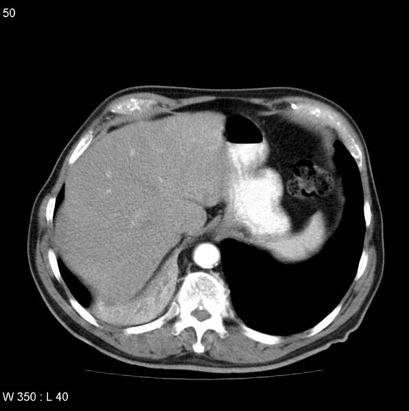 File:Bronchial carcinoid tumor with right lower lobe collapse (Radiopaedia 29060-29422 A 49).jpg